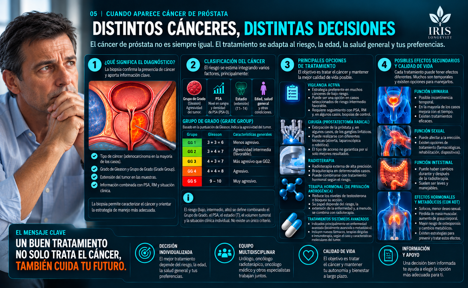 Infografía IRIS sobre diagnóstico, Grade Group, opciones terapéuticas y calidad de vida en cáncer de próstata